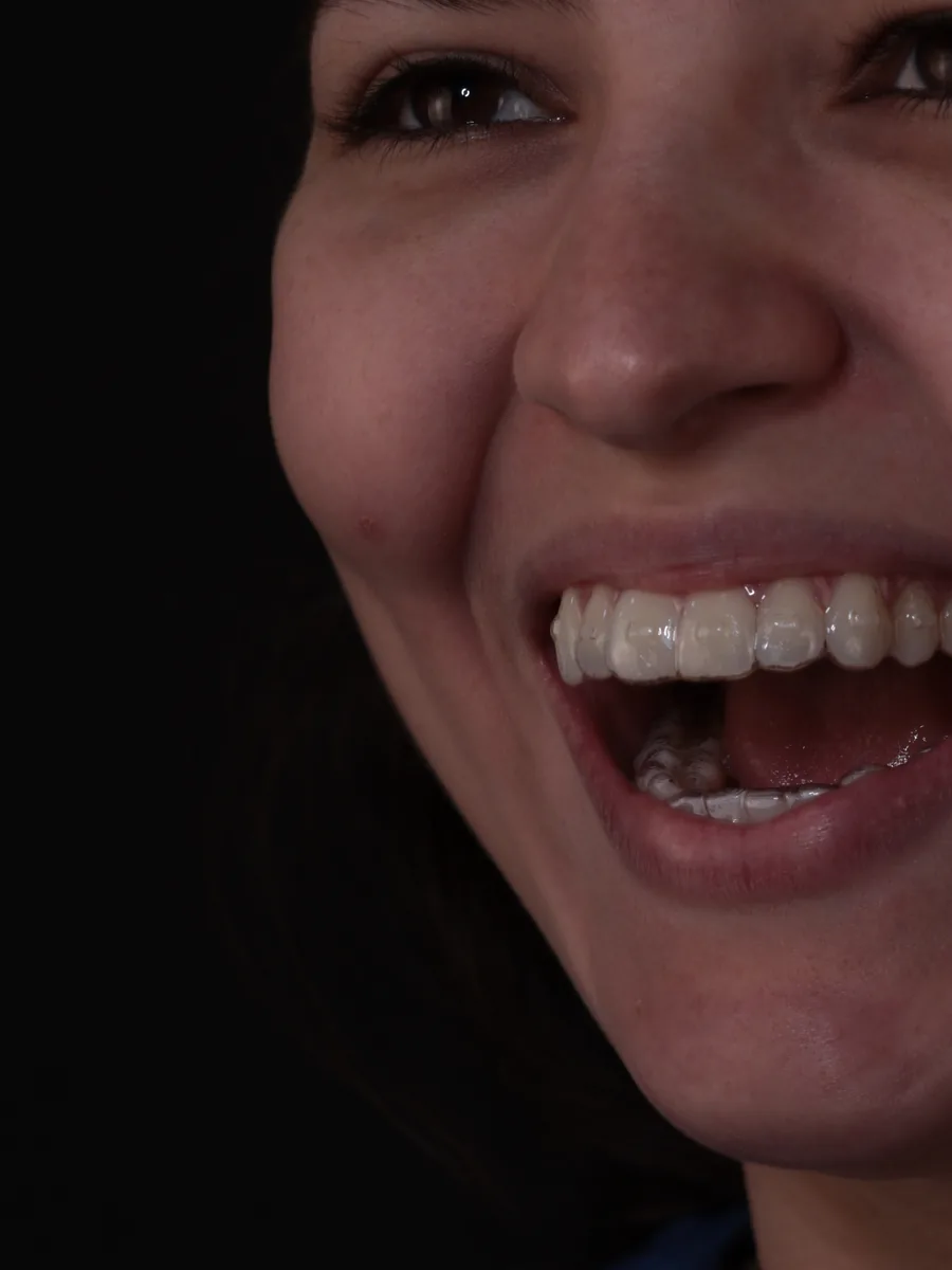 Paciente sorrindo com alinhador transparente na arcada superior