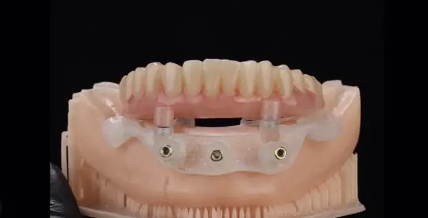 Prótese sobre implantes