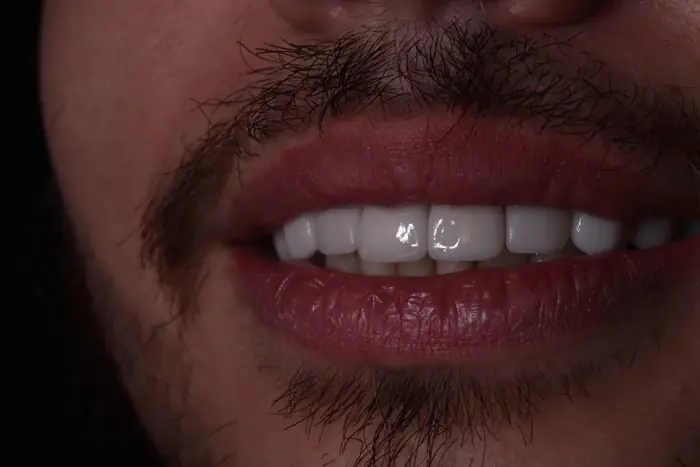 Sorriso reabilitado em cerâmica