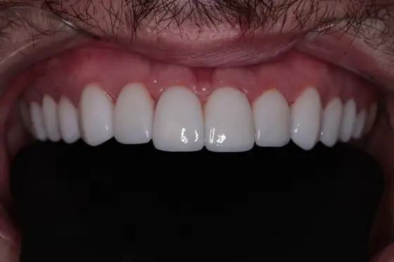 Sorriso finalizado em cerâmica